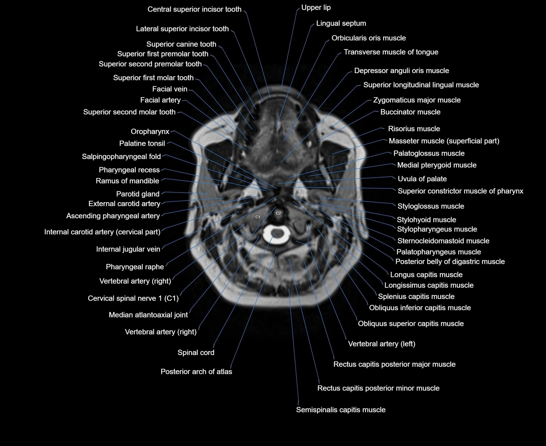 MRI Neck 3D labelled cross section anatomy axial 3t image-00001-00026.webp